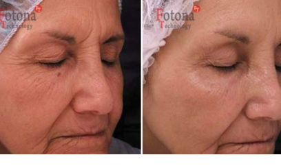 Фотона Глаза